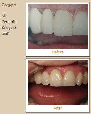 bridge-case1