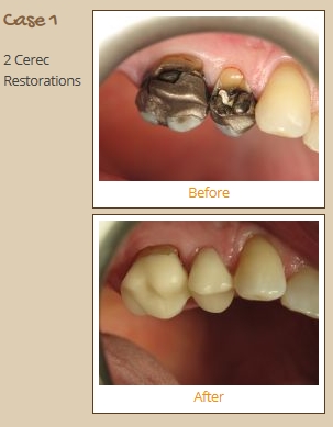 cerec-case1