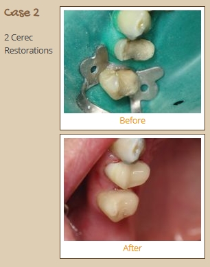 cerec-case2