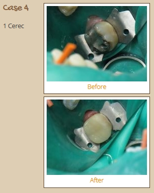 cerec-case4