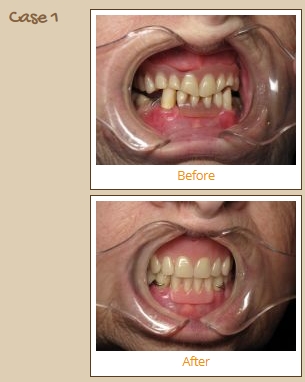 dentures-case1