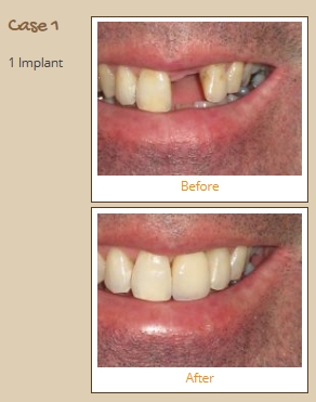 implant-case1