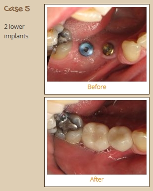 implant-case5