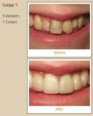 porcelain-veneers-case1