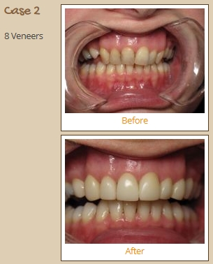 porcelain-veneers-case2