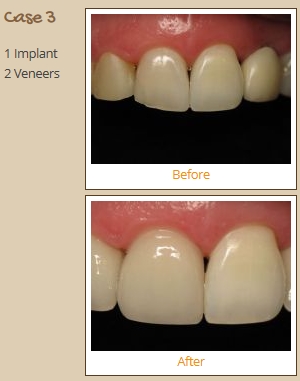 porcelain-veneers-case3