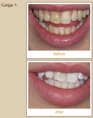 laser teeth whitening kerry