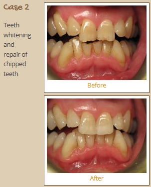 teeth-whitening-case2