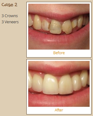 veneers-case2