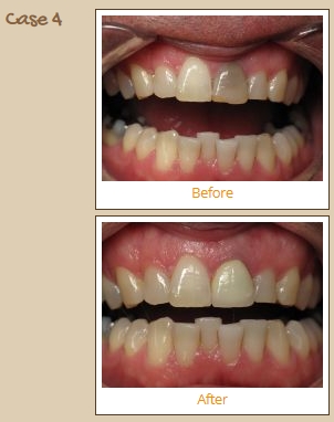 veneers-case4