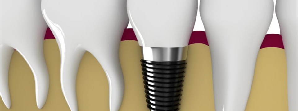 Implant Dentistry